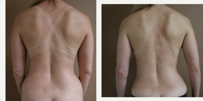 35-44 year old woman treated with Liposuction - This patient desired contouring of the love handles. Here she is 3 months status post liposuction of the love handles and lower back with J plasma skin tightening.