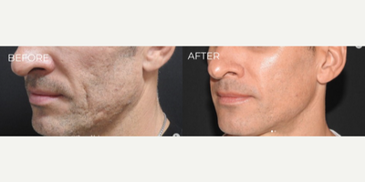 Man treated with Vampire Facial - Vampire facial (Microneedling + PRP)