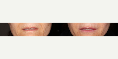 55-64 year old woman treated with Restylane Silk - Before and after Restylane Silk treatment for lip augmentation.