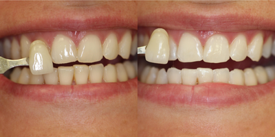 35-44 year old woman treated with Zoom Whitening - Zoom! Whitespeed in office whitening.