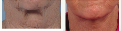 55-64 year old woman treated with Neck Lift for platysma bands - Corset platysmaplasty performed with lower facelift to eliminate neck bands