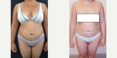 25-34 year old woman treated with Liposuction - When planning this 33 year old patient's mommy makeover, a 360 liposuction with Brazilian butt lift was added to provide a double benefit: reducing areas of unwanted fat while gaining a perkier, rounded buttocks. Each procedure must be planned according to the individual needs of patients, harvesting fat from target areas of the waist, back, and thighs and transferring it to create smooth, attractive contours. She spent two weeks recovering in Cartagena, and returned to New Jersey for the final phase of swelling resolution and skin tightening. Results shown at two months post op.