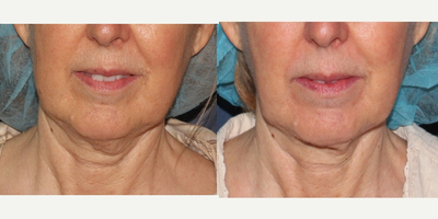 65-74 year old woman treated with ThermiTight - An older female patient undergoes a ThermiTight treatment to non-surgically tighten loose skin on the neck.