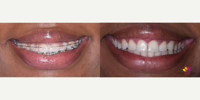 Cosmetic Dentistry Gum Lift to Treat Small Teeth - This young lady straightened her teeth and was having her braces removed and wanted to do something about the size of her teeth. In the before photo, you can see how small her teeth were. She had more gum tissue than she needed and it was covering up a portion of her teeth. We did a gum lift a/k/a as gum contouring after the braces were off. We removed some of the gum tissue around the top of her front teeth and uncovered more of her natural teeth. Now when she smiles, you can really see her beautiful teeth!