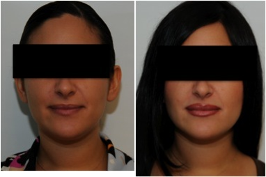 Evolence Injection Lips - Patient is seen before and one week following Evolence (Collagen) injection into her lips. Notice the natural fullness restored after the injections.