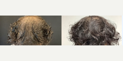 25-34 year old man treated with Hair Loss Treatment - Patient was treated with Exosomes for hair loss
