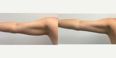 35-44 year old woman treated with CoolSculpting - Patient was treated with Coolsculpting to help reduce fat in her upper arms