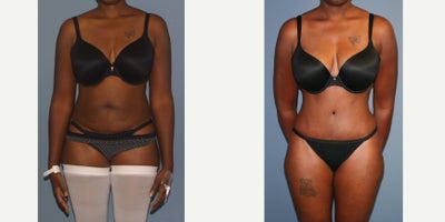 25-34 year old woman treated with Tummy Tuck - Full tummy tuck muscle tightening