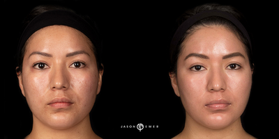 25-34 year old woman treated with Cosmelan - woman treated with cosmelan for pigmentation