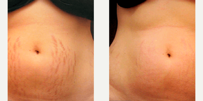 35-44 year old woman treated with Vivace - 3 Sessions VIVACE Stretch Marks + SkinCeuticals Body Tightening Concentrate