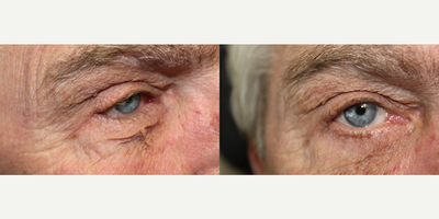 Man treated with Eyelid Retraction Repair - Man treated with Eyelid Retraction Repair