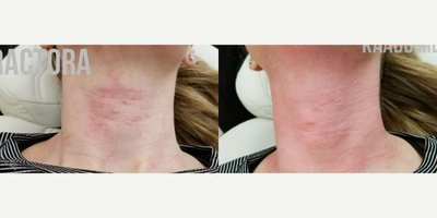 55-64 year old woman treated with Fractora RF - FRACTORA This is what should be expected right after FRACTORA treatment. Fractora was used to tighten patients neck