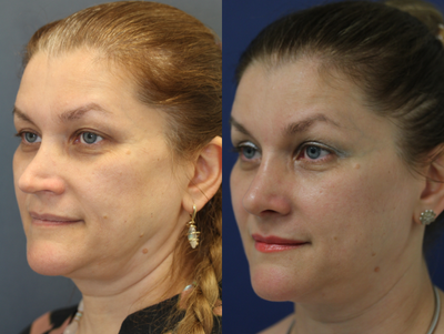 45-54 year old woman treated with Revision Rhinoplasty - Open Structure Revision Rhinoplasty