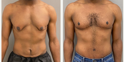25-34 year old man treated with Male Tummy Tuck, Gynecomastia Surgery, Masculinizing Top Surgery - 30 yo male s/p modified mastopexy for gynecomastia after massive weight loss and male tummy tuck performed in our on site AAAA certified operating suite