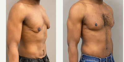 25-34 year old man treated with Male Tummy Tuck, Gynecomastia Surgery, Masculinizing Top Surgery - 30 yo male s/p modified mastopexy for gynecomastia after massive weight loss and male tummy tuck performed in our on site AAAA certified operating suite