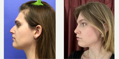 Patient treated with Adam's Apple Reduction, Forehead Reduction, Brow Lift, Facial Fat Transfer - 25 to 34 year-old female patient is 1 year post-op from Facial Feminization surgery. Her procedures included:Forehead Lift, Hairline Lowering, Superorbital Bone Reduction and ContouringSeptorhinoplasty (closed) with Cartilage Grafts and WeirsChin Reduction and ContourThyroid Cartilage ShaveVoice FeminizationFat Augmentation to Lips