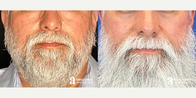 45-54 year old man treated with Microneedling, Sculptra - The patient is a 54-year-old male who sought treatment for uneven skin texture, acne scarring, fine lines, and wrinkles. To address these concerns, he received a full-face microneedling with PRP treatment, one Skin Sips treatment with Hyaluronic Acid (HA), and a series of three Sculptra treatments placed in the cheeks and temples. The results shown are 5 years after the start of treatment.