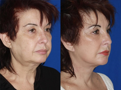 Woman treated with Lower Face Lift - Advanced Facelift