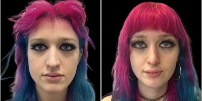 35-44 year old transgender woman treated with Facial Feminization Surgery - The transformational results of facial feminization surgery.