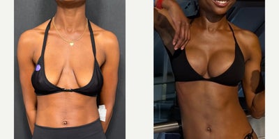 25-34 year old woman treated with Breast Lift, Breast Implants, Breast Lift with Implants, Breast Augmentation - Breast lift with 255 cc round implants