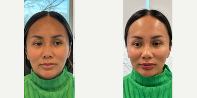 35-44 year old woman treated with Dermal Fillers, Cheek Augmentation, Lip Fillers - Immediately after cheek, chin, lip, pyriform, and pre jowl sulcus filler by RN Cindy