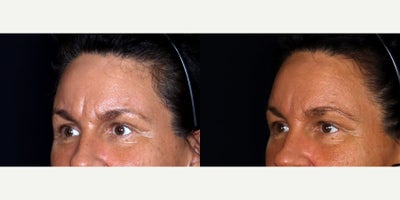 50 year old woman treated with Restylane Lyft to glabella - 50 year old woman treated with Restylane Lyft to glabella. Photos depict before and 1 month after treatment.