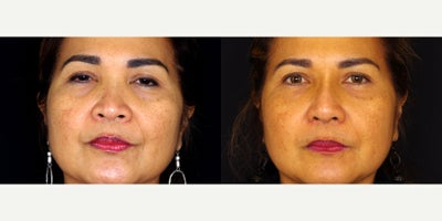 57 year old woman treated with Asian Rhinoplasty - 57 year old woman treated with Asian Rhinoplasty. Photos depict before and 3 months after surgery.