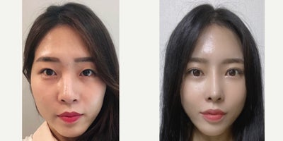 25-34 year old woman treated with Cheekbone Reduction, Asian Rhinoplasty, Double Eyelid Surgery - Incisional Double Eyelid SurgeryOpen- Rhinoplasty- OsteotomyCheekbone Reduction