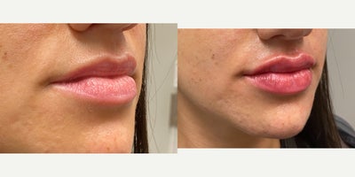 25-34 year old woman treated with Restylane Kysse - Restylane Kysse lip fillers with Dr. Wise at the Wise Center for Plastic Surgery in Wayne, NJ to create a plumped up and symmetrical look!