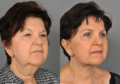 72 year old woman treated with Facelift - 72 year old woman treated with full SMAS Lamellar Facelift