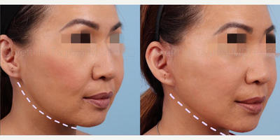 Woman treated with Facelift - This is a #beforeandafter of patient 3 months after surgical #facelifting for a more youthful #Vline contour