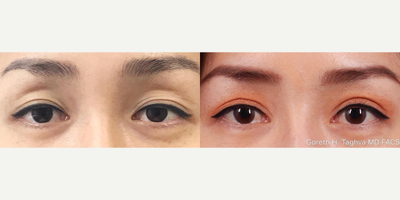 Woman treated with Double Eyelid Surgery - #Beforeandafter of a patient 6 months after her #asianeyelidsurgery. She complained of inconsistent eyelid crease that required daily use of eyelid tape.Chronic use of eyelid tape/ glue can damage the delicate eyelid skin by stretching out the skin and making it saggy. Frequent application can also cause inflammation of the eyelids due to reaction to the adhesive. If you are looking for a more permanent result, #doubleeyelid surgery may be a better long term option.