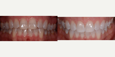 35-44 year old woman treated with Teeth Whitening - KOR Whitening deep Bleaching system of upper and lower teeth from Tetracycline Staining. Custom fitted trays are made and will result in longer lasting, whiter teeth with two in-office bleachings.