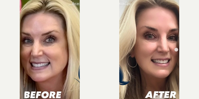 Woman treated with Botox - Woman treated with Botox