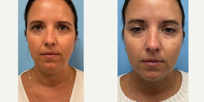 35-44 year old woman treated with ThermiTight - 38 year old female underwent a ThermiTight procedure under local anesthesia.