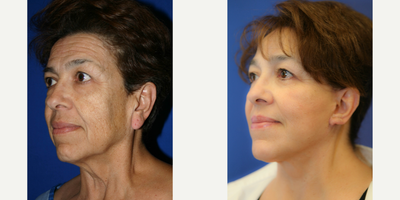Ear Lobe Surgery (side view (QL) - This is a 61 year old female. She was not happy with the appearance of her face or neck. She underwent a face lift, neck lift, brow lift, upper and lower blepharoplasty and earlobe reduction.
