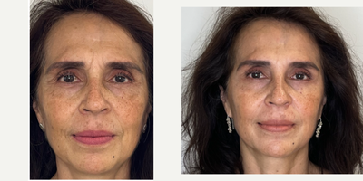 65-74 year old woman treated with Profhilo, Botox, Mesotherapy - Skin rejuvenation