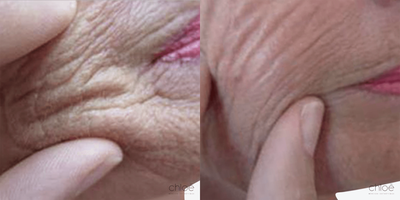 Reduce Face Wrinkles using Mesotherapy - Wrinkles and fine lines of the face appear over time following repeated movements as well as with the gradual loss of collagen. This condition can be effectively treated with mesotherapy.