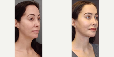 Woman treated with Brow Lift - Woman treated with Deep Plane Facelift, Lateral Brow Lift, and Facial Fat Transfer, shown 1 month post op.