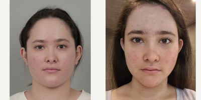 18-24 year old woman treated with AccuLift, Cheekbone Reduction, Facial Fat Transfer, Forehead Reduction, Nonsurgical Facelift,  - .