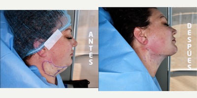 35-44 year old woman treated with Kybella, Botox, Aqualyx - i did double chin removal and marking jawline.
