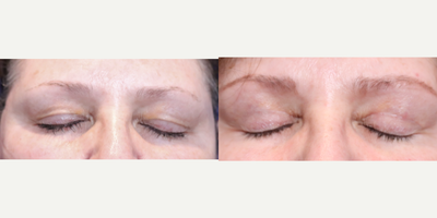 55-64 year old woman treated with Eyelid Surgery - Primary facelift. Fat injections, 38 cc. Upper lid blepharoplasty, bilateral