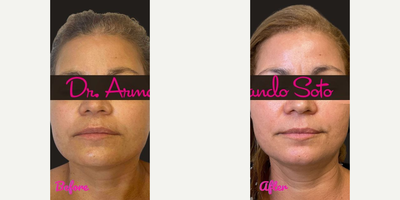 Woman treated with Moxi - We were able to achieve her results through only ONE Moxi laser treatment and her results will only improve with subsequent treatments.
