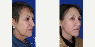 55-64 year old woman treated with Brow Lift, Eyelid Surgery - 55-64 year old treated with Brow Lift, Eyelid Surgery