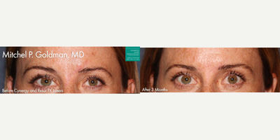 25-34 year old woman treated with Scar Removal - Cynergy laser used to remove scar from forehead of a female patient by Dr. Goldman.