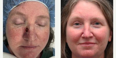 35-44 year old woman treated with Mohs Surgery - This lovely patient had a skin cancer on the side of the nose that was treated with mohs surgery by her dermatologist with the reconstruction by our team shortly after. We are so happy with how well she is healing as it is already difficult to see any incisions or scar and this will only continue to improve over time.