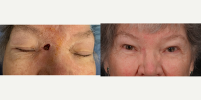 65-74 year old woman treated with Mohs Surgery - Another amazing patient who had an unfortunate skin cancer which was treated by mohs surgery and reconstructed by our team. Here she is at just one month after repair! She has healed wonderfuly and we are all so happy for her!