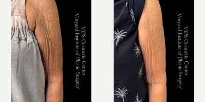 65-74 year old woman treated with Skin Tightening, Skin Rejuvenation, Microneedling RF, Morpheus8 - Morpheus8 Body before and after by VIPS Cosmetic Center in Port St. Lucie, FL. After just one Morpheus8 Body RF microneedling treatment to the upper arms, this patient shows visible improvement in mild fat reduction, skin laxity, and crepey skin texture for a smoother, firmer arm contour.