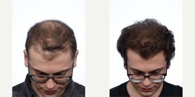 23 year old man treated with FUE Hair Transplant, PRP for Hair Loss - Goals: To combat crown thinning and temporal recession Procedure: FUE hair transplant and PRP Hair TherapyGrafts: 3030 grafts, zones 1,2 and 4Photo Timeline: 6 months post-op