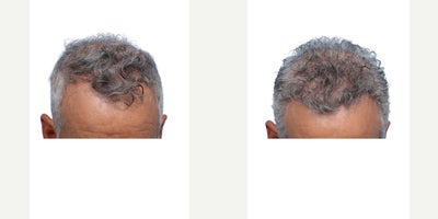 59 year old man treated with FUE Hair Transplant, PRP for Hair Loss - Goals: To fortify and strengthen his front hairline and density on the crownProcedure: FUE hair transplant and PRP Hair TherapyGrafts: 4050 grafts, zones 1 and 4Photo Timeline: 6 months post-op